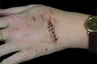 bite injury from a young spectacled caiman - photo &copy; Bill Moss
